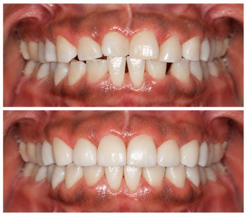Before & After Result